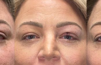 patient had reconstructive surgery, shown before (left), 16 days after (middle), and 2 months after (right)