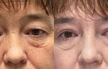 patient had ptosis repair and brow repair, shown before (left) and 20 days after surgery (right)