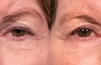 patient had ptosis repair and lesion removal shown frontal before (left) and 1 week after (right)