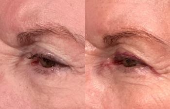 patient had ptosis repair and lesion removal shown left oblique before (left) and 1 week after (right)