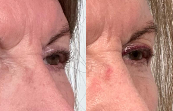 patient had ptosis repair and lesion removal shown right oblique before (left) and 1 week after (right)