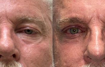 Patient had ptosis repair and upper blepharoplasty, shown before and 6 days after surgery, Dr. Eftekhari
