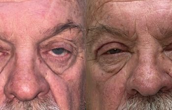 patient had ptosis repair shown before (left) and after (right)