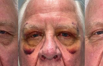 patient had ptosis repair, upper blepharoplasty, and brow repair shown before (left), 6 days after (middle), and 2 months after (right)