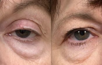 patient had ptosis repair shown frontal before (left) and 3 weeks after (right)