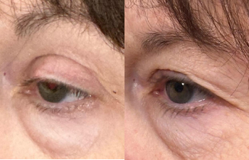 patient had ptosis repair shown left oblique before (left) and 3 weeks after (right)