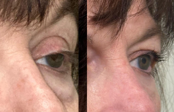 patient had ptosis repair shown right oblique before (left) and 3 weeks after (right)