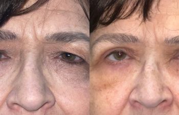 patient had upper blepharoplasty and brow repair shown frontal before (left) and 10 days after (right)