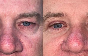 patient had upper blepharoplasty and brow repair shown frontal before (left) and 2 months after (right)