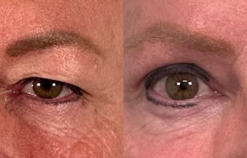 patient had upper blepharoplasty shown frontal before (left) and 1 month after (right)