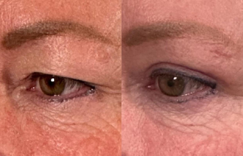 patient had upper blepharoplasty shown left oblique before (left) and 1 month after (right)