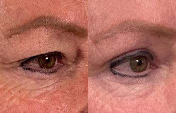patient had upper blepharoplasty shown right oblique before (left) and 1 month after (right)