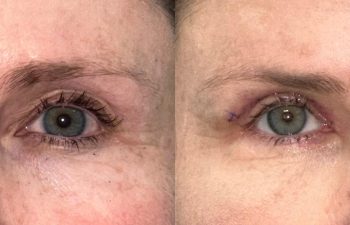 patient had upper blepharoplasty shown frontal before (left) and 1 week after (right)
