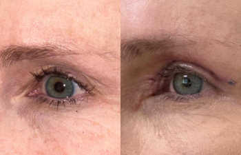 patient had upper blepharoplasty shown left oblique before (left) and 1 week after (right)