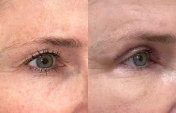 patient had upper blepharoplasty shown right oblique before (left) and 1 week after (right)