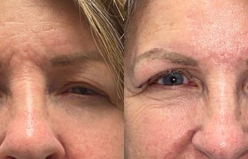 patient had upper blepharoplasty shown frontal before (left) and 10 days after (right)