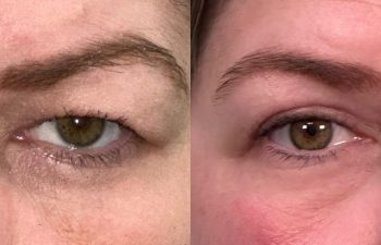 patient had upper blepharoplasty shown frontal before (left) and 2 months after (right)