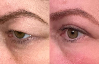 patient had upper blepharoplasty shown left oblique before (left) and 2 months after (right)