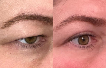 patient had upper blepharoplasty shown right oblique before (left) and 2 months after (right)