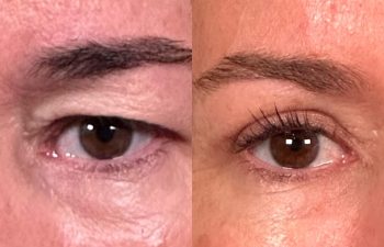 patient had upper blepharoplasty shown frontal before (left) and 3 weeks after (right)