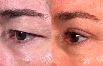 patient had upper blepharoplasty shown left oblique before (left) and 3 weeks after (right)