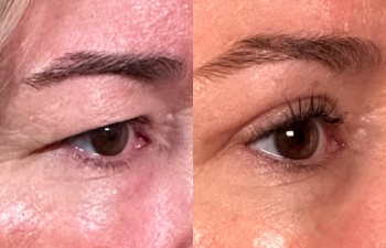 patient had upper blepharoplasty shown right oblique before (left) and 3 weeks after (right)