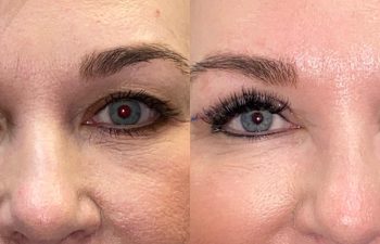 patient had upper blepharoplasty shown frontal before (left) and 6 days after (right)