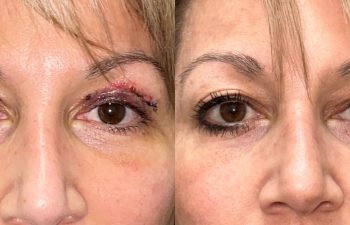 patient had upper blepharoplasty shown frontal before (left) and 7 days after (right)