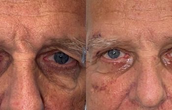 patient had upper blepharoplasty shown frontal before (left) and after (right)