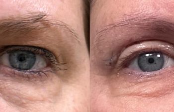 patient had upper blepharoplasty shown frontal before (left) and after (right)