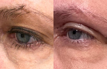 patient had upper blepharoplasty shown left oblique before (left) and after (right)