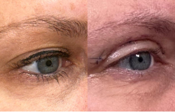 patient had upper blepharoplasty shown right oblique before (left) and after (right)