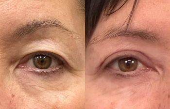 patient had upper blepharoplasty, lateral forehead lift, and fat grafting shown frontal view: before (left), 1 week after (middle), and 2 months after (right)