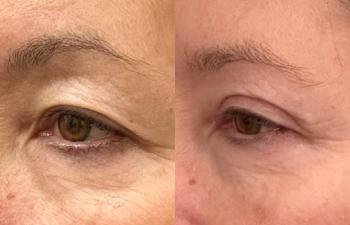 patient had upper blepharoplasty, lateral forehead lift, and fat grafting shown left oblique view: before (left), 1 week after (middle), and 2 months after (right)