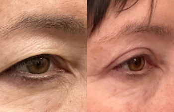 patient had upper blepharoplasty, lateral forehead lift, and fat grafting shown right oblique view: before (left), 1 week after (middle), and 2 months after (right)