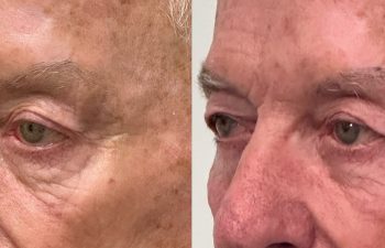 patient had ectropion and ptosis repair, shown in left oblique view before (left) and 3 months after surgery (right)