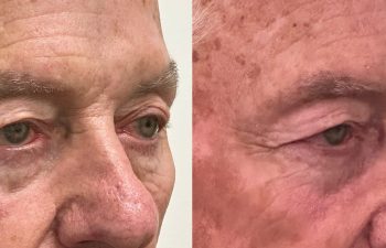 patient had ectropion and ptosis repair, shown in right oblique view before (left) and 3 months after surgery (right)