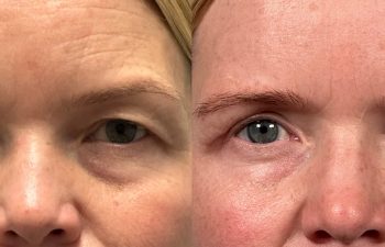 patient had endoscopic brow lift, bilateral upper blepharoplasty, fat grafting, and lower blepharoplasty, shown in frontal view before (left) and 6 months after surgery (right)