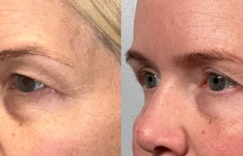 patient had endoscopic brow lift, bilateral upper blepharoplasty, fat grafting, and lower blepharoplasty, shown in left oblique view before (left) and 6 months after surgery (right)