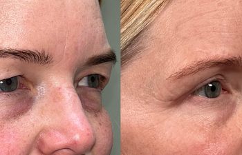 patient had endoscopic brow lift, bilateral upper blepharoplasty, fat grafting, and lower blepharoplasty, shown in right oblique view before (left) and 6 months after surgery (right)