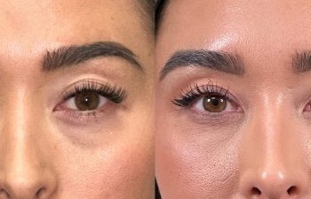 patient had bilateral lower blepharoplasty and fat grafting, shown in frontal view before (left) and 3 months after surgery (right)