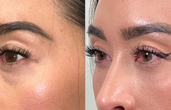 patient had bilateral lower blepharoplasty and fat grafting, shown in left oblique view before (left) and 3 months after surgery (right)
