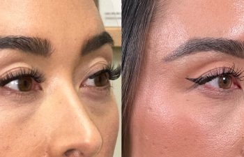 patient had bilateral lower blepharoplasty and fat grafting, shown in right oblique view before (left) and 3 months after surgery (right)