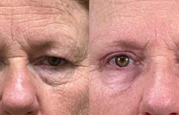 patient had bilateral upper and lower blepharoplasty, direct brow lift, and lower lid TCA peel, shown in frontal view before (left) and 2 months after surgery (right)