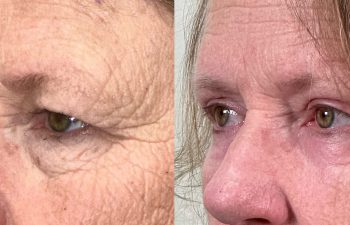 patient had bilateral upper and lower blepharoplasty, direct brow lift, and lower lid TCA peel, shown in left oblique view before (left) and 2 months after surgery (right)