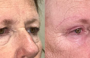 patient had bilateral upper and lower blepharoplasty, direct brow lift, and lower lid TCA peel, shown in right oblique view before (left) and 2 months after surgery (right)