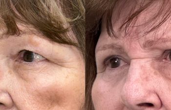 patient had bilateral upper blepharoplasty, shown in left oblique before (left) and 3 months after surgery (right)