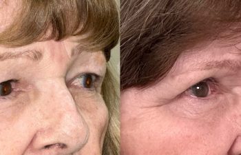 patient had bilateral upper blepharoplasty, shown right oblique before (left) and 3 months after surgery (right)