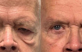 patient had bilateral upper and lower eyelid blepharoplasty with a transcutaneous lower lid approach and festoon correction, shown in frontal view before (left) and 5 months after surgery (right)