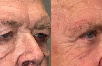 patient had bilateral upper and lower eyelid blepharoplasty with a transcutaneous lower lid approach and festoon correction, shown in right oblique view before (left) and 5 months after surgery (right)